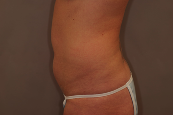 Tummy Liposuction before 229692
