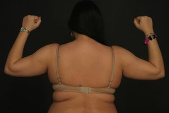 Liposuction before 315604