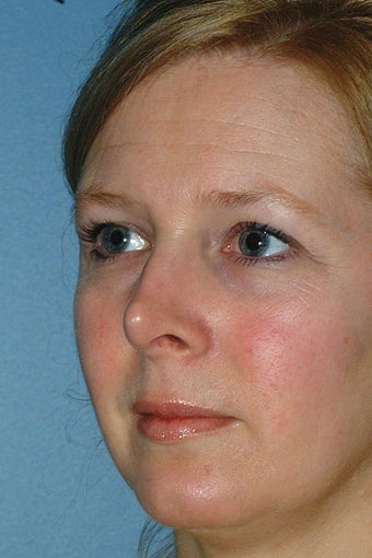 Revision Rhinoplasty before 81103