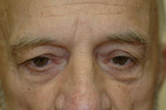 Brow lift 366292
