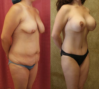 Tummy tuck with breast lift 587843