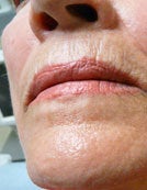 Fraxel Re:pair for Skin Rejuvenation after 196057