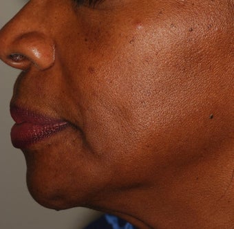 Radiesse Treatment before 119419