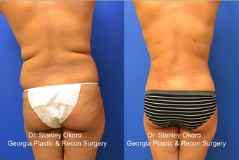 SmartLipo of Back Bra Rolls and Waist Line before 568402