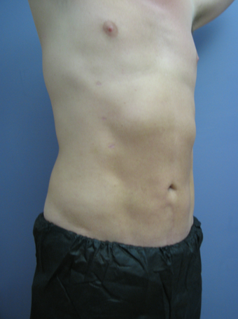 Tummy Liposuction after 229696