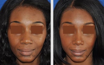 African American Rhinoplasty after 495714