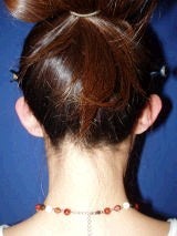 Ear Surgery (Otoplasty) before 357653