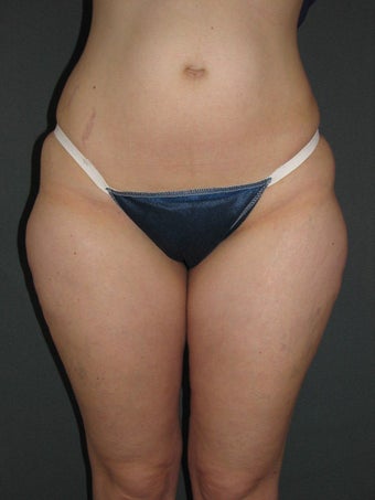 Smart Lipo of Hips, Saddle Bags, and Inner Thighs before 325110
