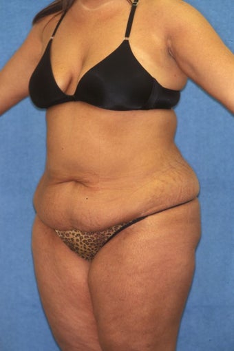 Tummy Tuck with Liposuction 411595