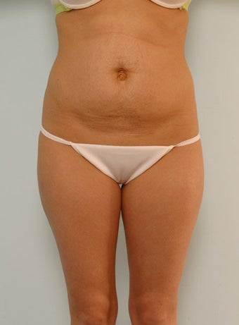 Liposuction Hips Thighs and Knees Abdominoplasty Mommy Makeover before 260306