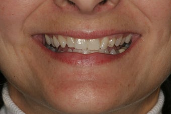 Smile Makeover with Minimal-Prep Porcelain Veneers before 94814