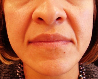 Nasolabial Fold Treatment before 271684