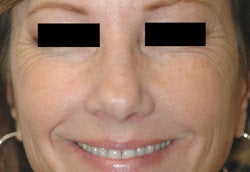 Botox for Crows Feet before 93348