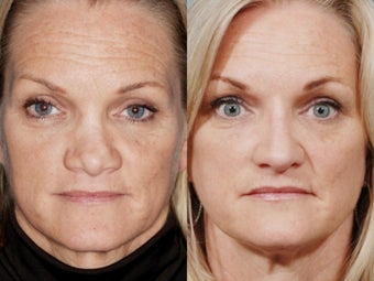 Revision rhinoplasty before 334265