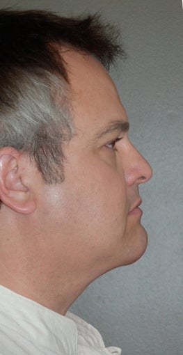 Chin Augementation after 273279