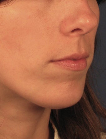 Chin Implant after 414148