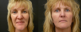Liquid Facelift - no surgery enhancement using fillers before 603993