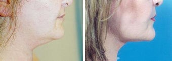 Chin Liposuction before 640745