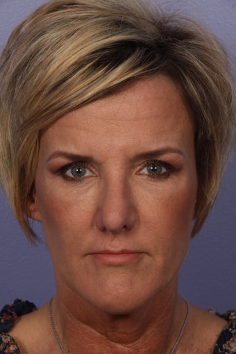 Botox after 333880