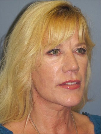 Neck Lift, Platysmaplasty 634737