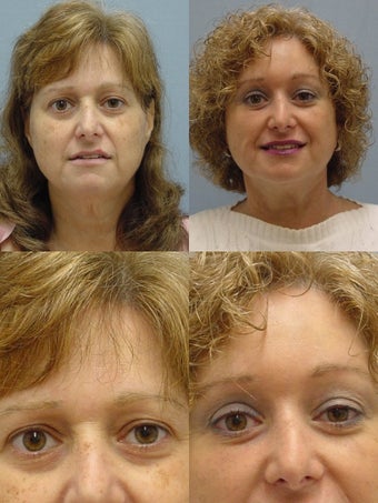 Face Lift before 89349