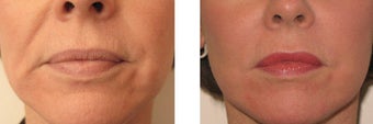 Juvederm and Botox around mouth before 69356