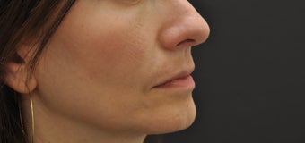 Juvederm Ultra after 194333