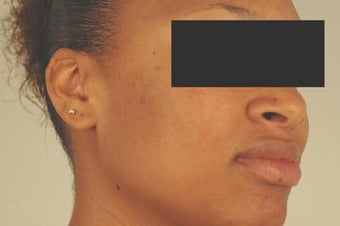Laser Acne Scar Removal after 82947