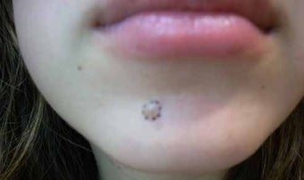 Mole Removal before 513301