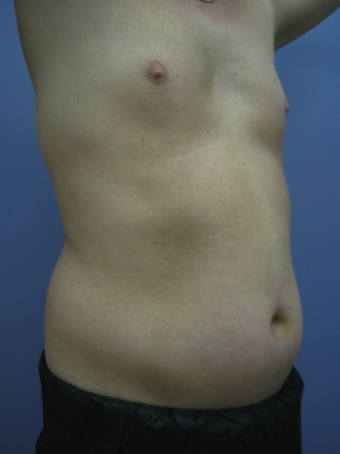 Tummy Liposuction before 229696