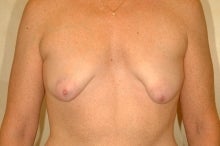 Full Mastopexy Augment to Correct Breast Asymmetry before 177525