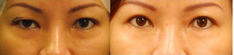 Asian Eyelid Surgery before 407928
