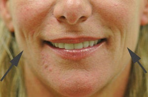 Restylane for cheek augmentation before 93358