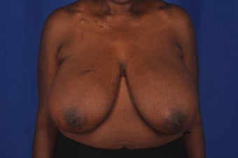 62 year-old woman desired bilateral breast reduction before 647695