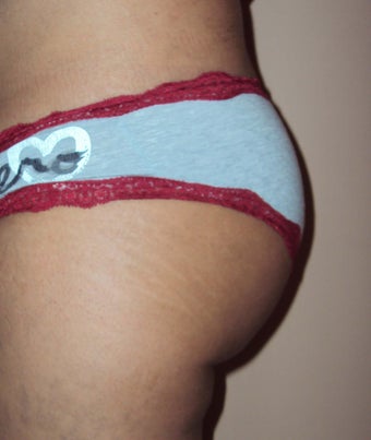 Butt implant augmentation after 266046