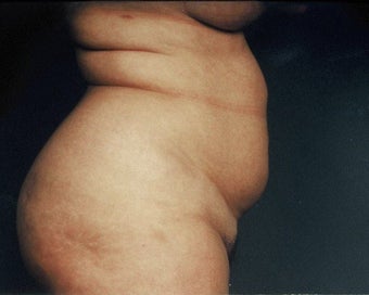 Liposuction before 217864