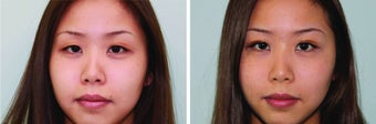 Double eyelid surgery suture before 548949