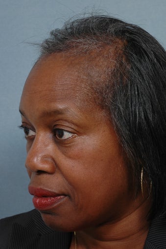 Hair Transplantation 358854