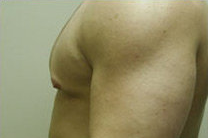 Male Breast Reduction 141526