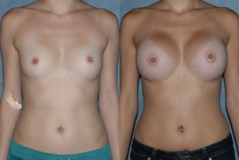 Breast Augmentation - Silicone Implants before 118037