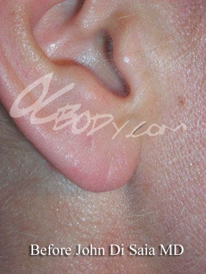 Ear Repair - Earlobe after 84599