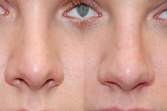 Non-Surgical Rhinoplasty. Front view. before 170671