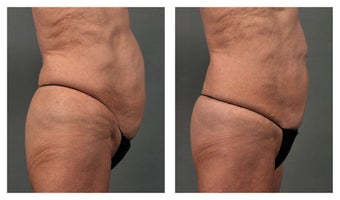 CoolSculpting Abdomen before 541959