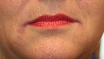 Restylane and Radiesse after 240864