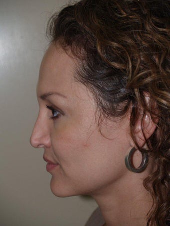 Revision Rhinoplasty 330464
