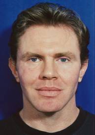 Facial Fat Grafting after 75985