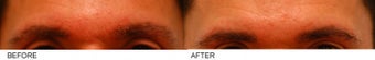 Eyebrow Hair Transplant before 137284