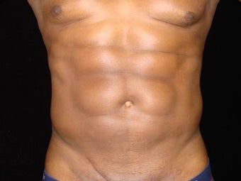 Liposuction of Abdomen, Waist, Flanks with 6 Pack Abdominal Etching after 203523