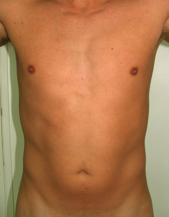 Tummy Liposuction before 229657