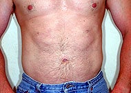 Liposuction after 74772